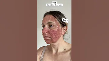 CO2 Fractional Laser Recovery Day By Day 