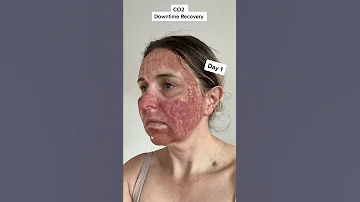 CO2 Fractional Laser: Recovery Day by Day
