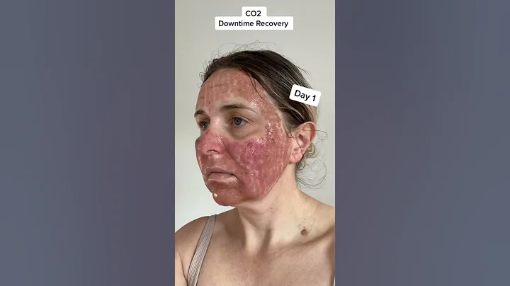 CO2 Fractional Laser: Recovery Day by Day - DayDayNews