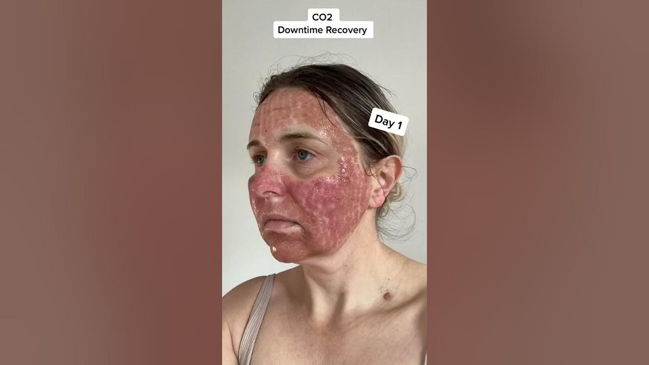 CO2 Fractional Laser: Recovery Day by Day