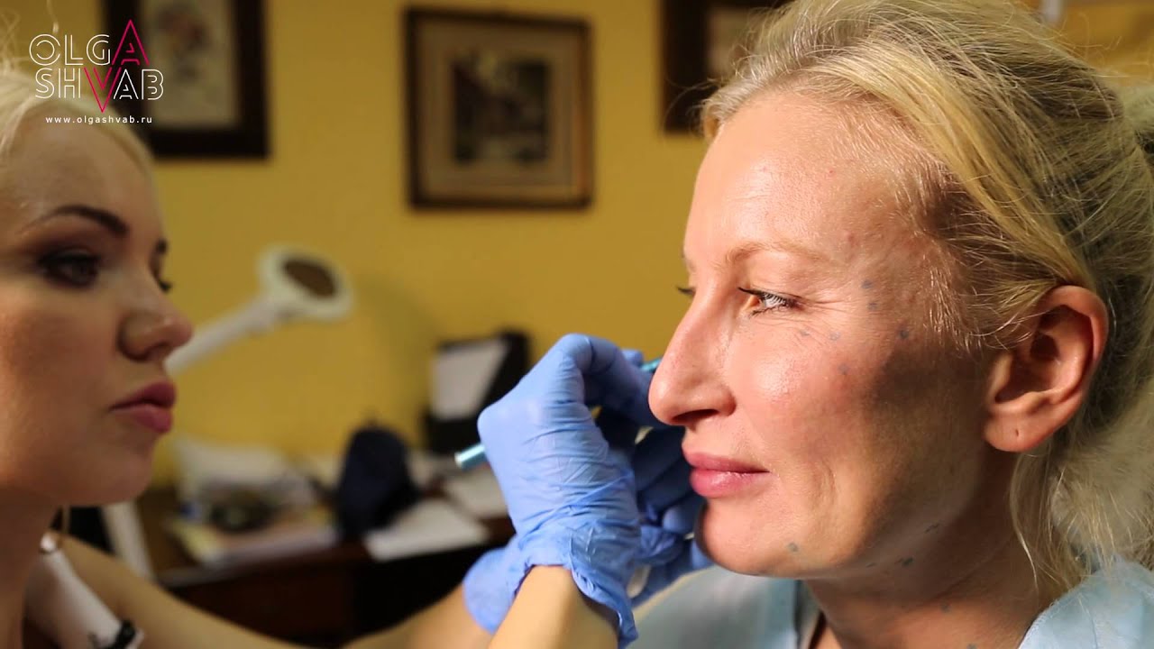 3D-Facial Contouring and Volumization. Бьютификация лица.