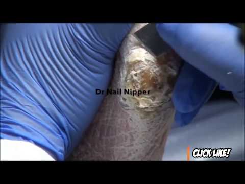 Video: Onicogryphosis (Ram's Horn Nails): Cause E Trattamento