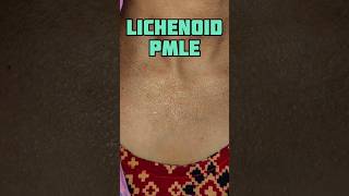 Lichenoid Pmle Vs Actinic Lichen Nitidus