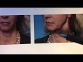 Lower Facelift - Lifting the Face and Neck - Before and After - Dr. Anthony Youn