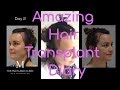 Female Hairline Lowering - Laura's Diary Day 1 to Day 6 and 14 Months