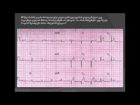 მიოკარდიუმის გადატანილი ინფარქტი /გულის იშემია / ფიზიკური დატვირთვის სინჯი (ტრედმილ ტესტი)