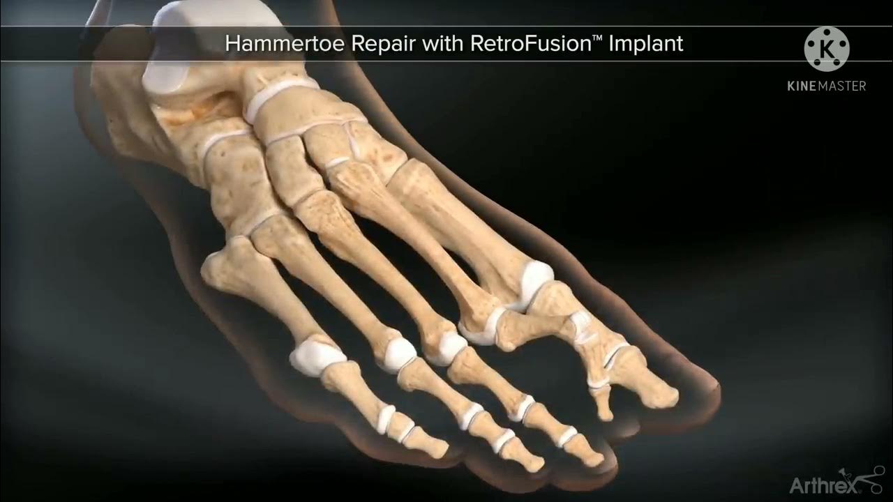 Hammertoe Repair with Retrofusion™ implant. YouTube