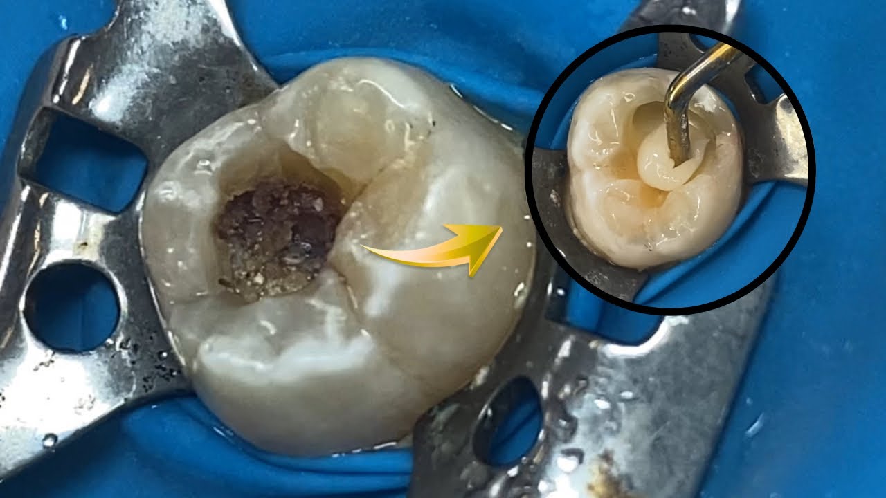 AMAZING reconstruction of a tooth damaged by decay: Restoration