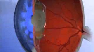 Multifocal Intraocular Lens: How Does It Work?