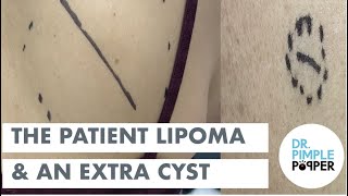 The Patient Lipoma and Extra Cyst