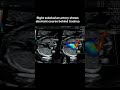 ARSA on anomaly scan – what next?