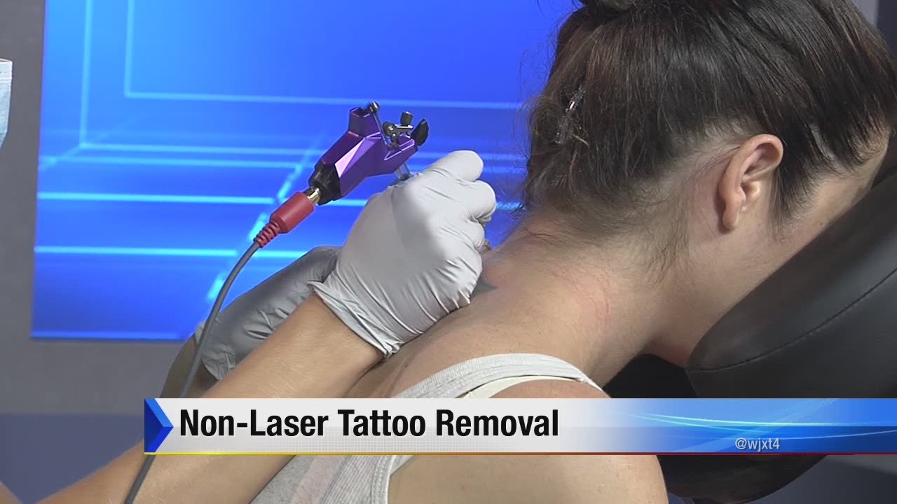 Non-laser tattoo removal - YouTube