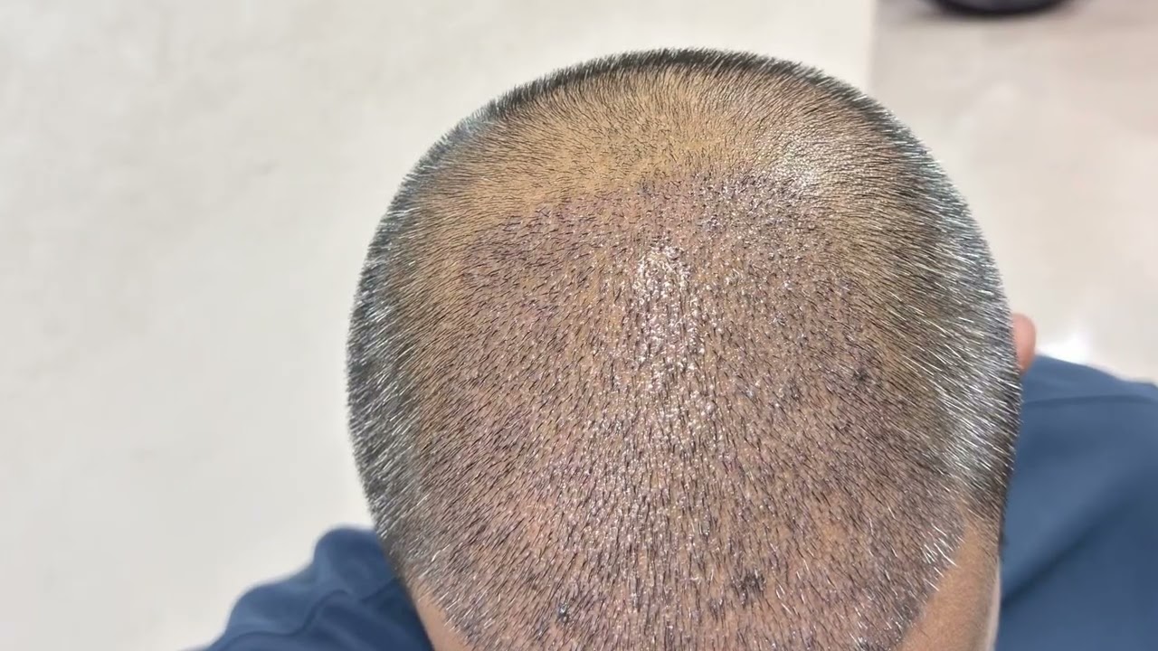😱shocking result hair transplant! 