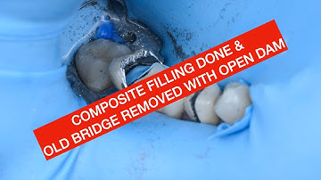 COMPOSITE FILLING DONE AND OLD PFM BRIDGE REMOVED WITH OPEN DAM