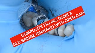 COMPOSITE FILLING DONE AND OLD PFM BRIDGE REMOVED WITH OPEN DAM