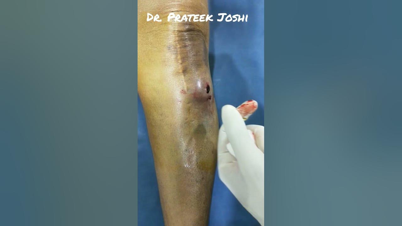 Incision and drainage of hematoma dr prateek joshi youtube