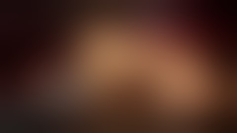 Lap Spleen preserving Distal Pancreatectomy