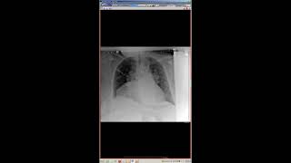 STR Cardiothoracic Case Webinar 8/23/2018
