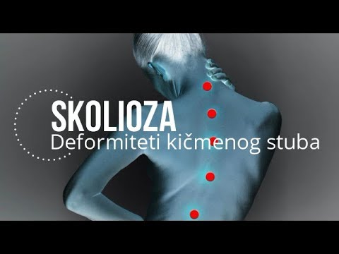 Deformacija kičmenog stuba I Deo - Skolioza kako je otkriti, izmeriti i smanjiti