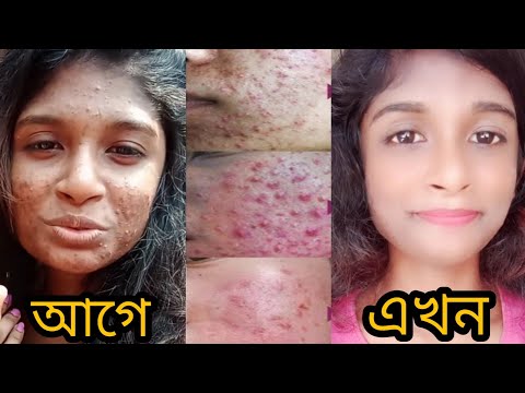 এমন ভয়ঙ্কর ব্রন আল্লাহ যেন আর কাউকে না দেয়! ব্রন ও কালো দাগে  নষ্ট হওয়া স্কিন ঠিক করার উপায়!khadja