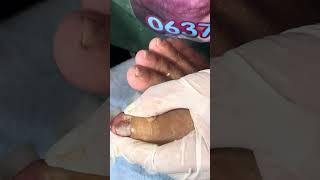 Ep_6556 Foot nails skin removal 👣 เก็บเอาไว้นาน..ถึงเวลาต้องเอาออก 😄 (clip from Thailand)