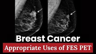 Breast Cancer Imaging: Appropriate Uses of FES PET