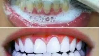 كيف تبيض الأسنان في المنزل بشكل طبيعي نتيجة مدهلة