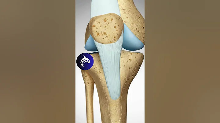 See how a Misaligned Knee Cap is fixed // Tibial Tubercle Osteotomy (TTO)