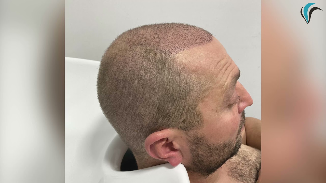 طريقة غسيل الرأس بعد زراعة الشعر