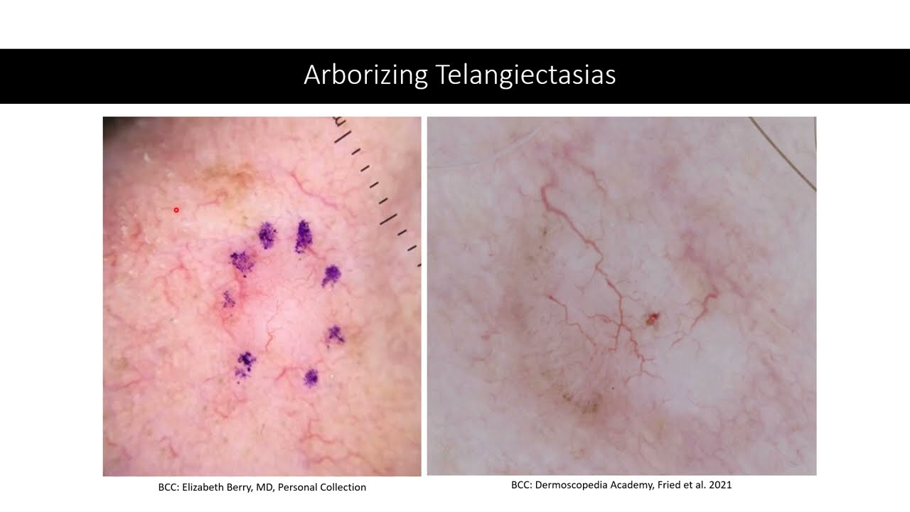 Non-pigmented BCC - Dr. Elizabeth Berry