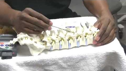 Spinal Cord Stimulation and Neuromodulation