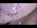 Plucking facial hair & ingrown hair 928 頬髭抜き(埋没毛あり)