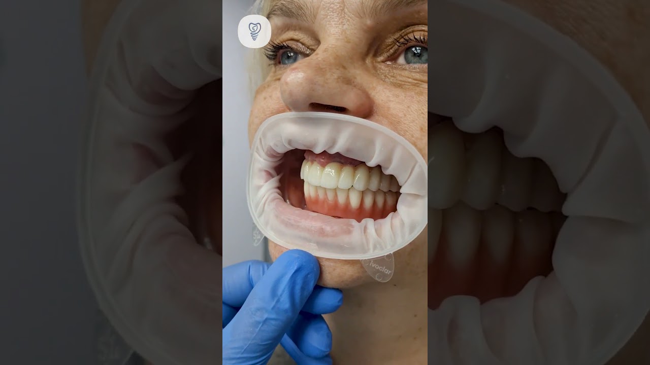 10 зубов на удаление и установка 8 имплантатов. Имплантация зубов. 