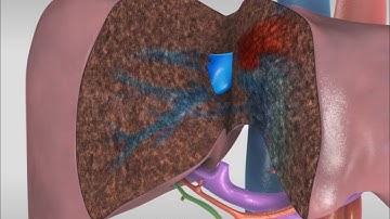 Extended left hepatectomy with in situ cold perfusion