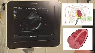 Quick guide to focused ECHO for critical care and emergency medicine