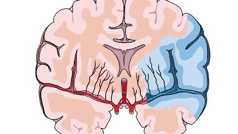 USMLE Step 2 CK Plus | Chapter 2: Neurology - Stroke