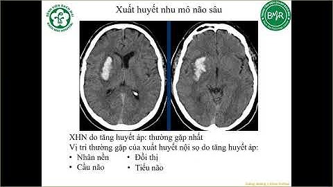 CHẨN ĐOÁN HÌNH ẢNH ĐỘT QUỴ THIẾU MÁU NÃO CẤP VÀ VAI TRÒ CỦA ĐIỆN QUANG CAN THIỆP | BS. Nguyễn Hữu An