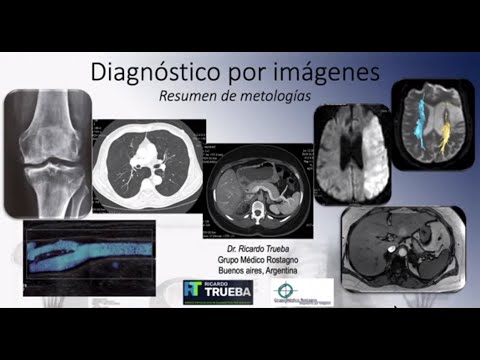 Vídeo: El Papel De Las Técnicas De Diagnóstico Por Imagen No Invasivas E Invasivas Para La Detección De Anomalías Del Sistema Venoso Extracraneal Y Variantes De Desarrollo