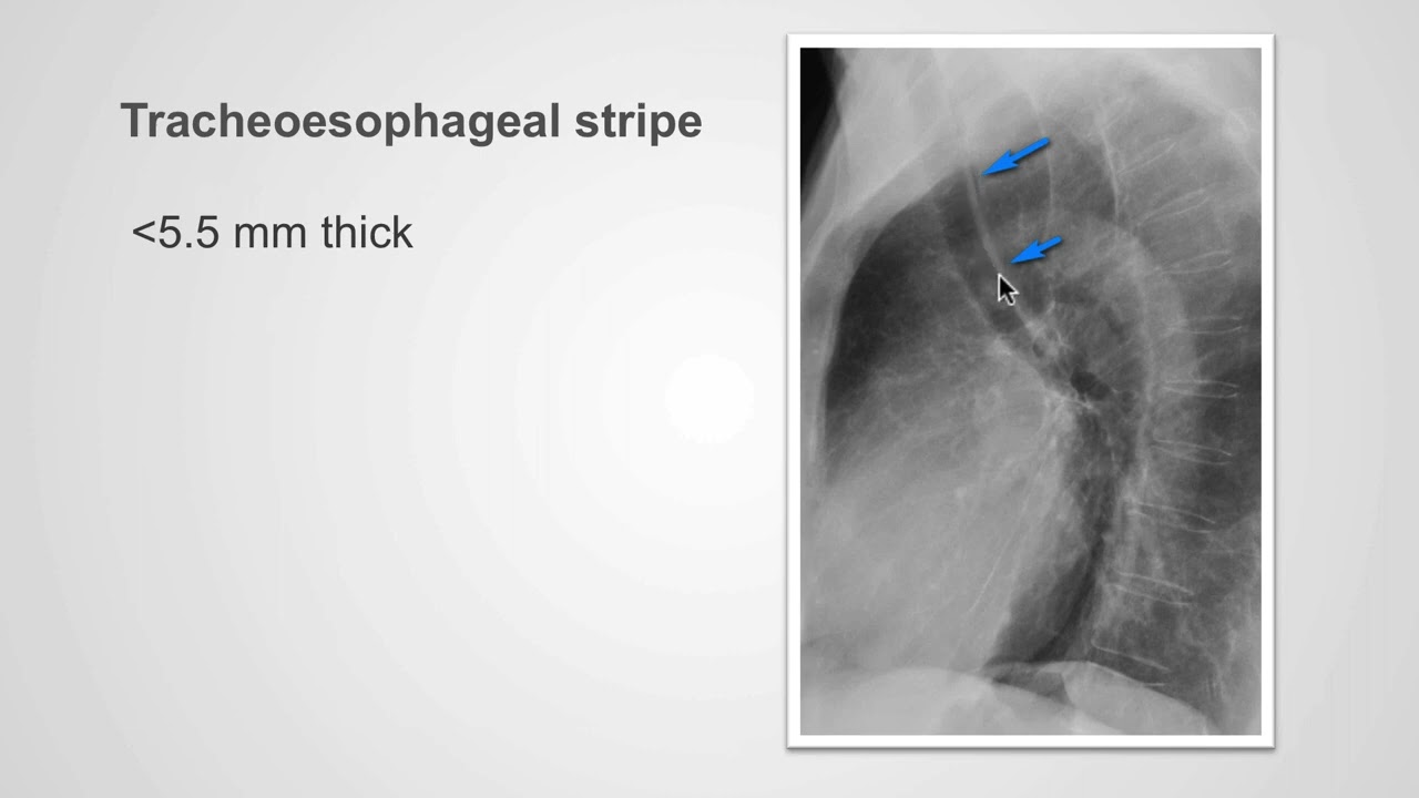 03. Trachea and major bronchi -