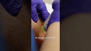 Laser Beard Removal: No More Shaving Twice a Day!