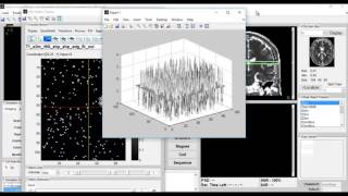 BRAIN TUMOR MRI CLASSIFICATION METHODS USING PROBABILISTIC MATLAB PROJECTS