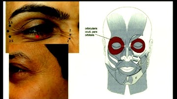 AIOC2018 - IC532 - Topic - Cosmetic Periorbital Indications of Botulinum Toxin - Dr.Adit Gupta