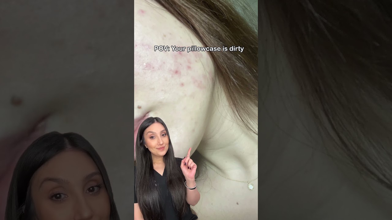 Your pillowcase can cause acne 