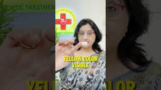 Acupressure Point for Varicose Veins | Spider Veins Natural Treatment