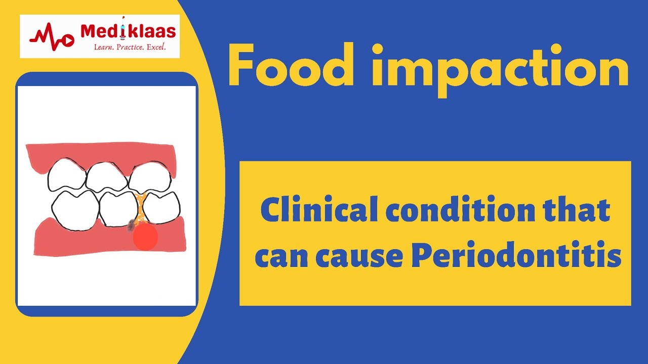 Food impaction A cause for periodontitis Caries gum problem