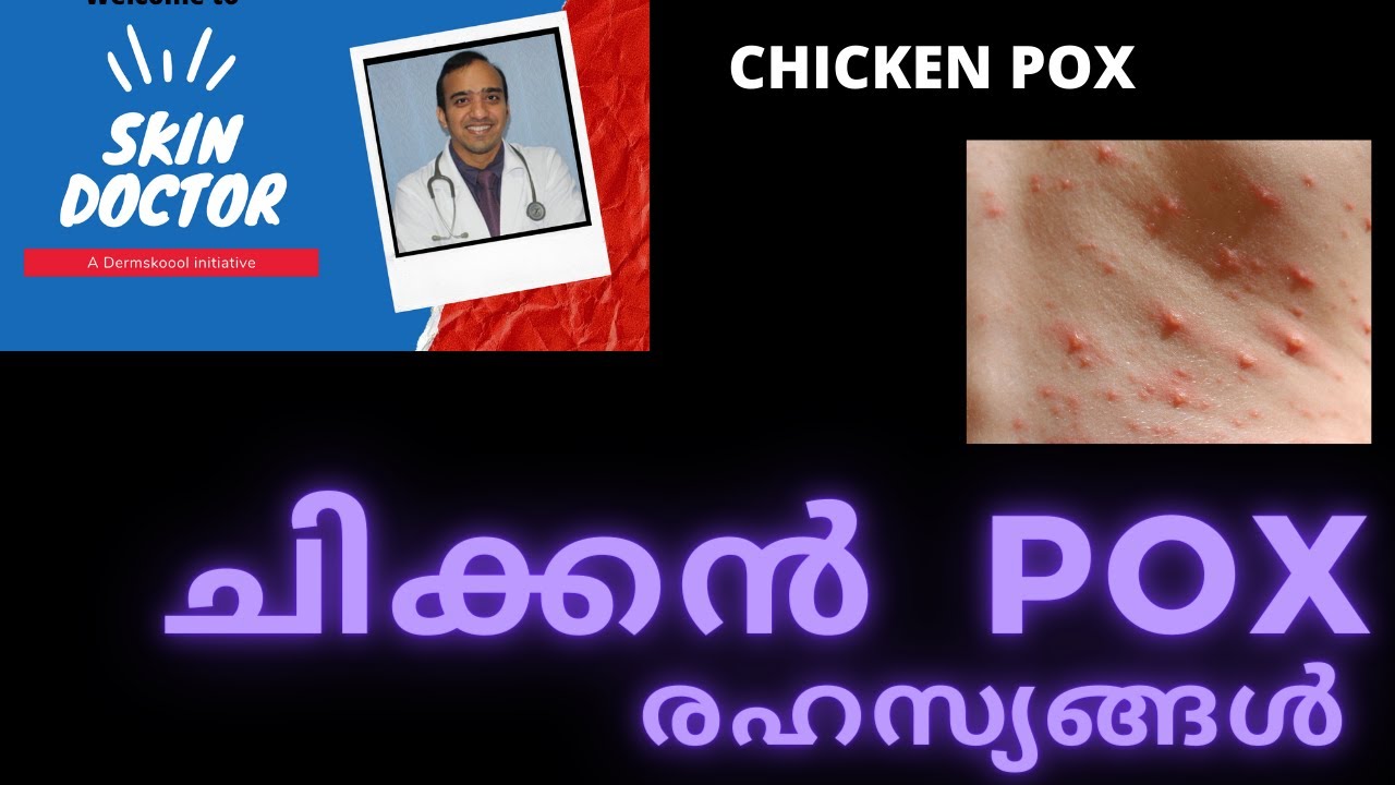 Chicken pox malayalam/ chicken pox complications malayalam /Dr