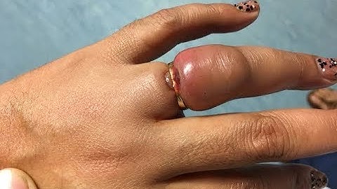 How do you remove a ring from a swollen finger