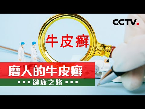 “不死的癌症”其实并不可怕 专家帮你正确认识银屑病！20210525 |《健康之路》CCTV科教