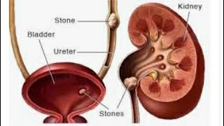 kidney stones, पथरी,का इलाज अब होगा  Uni +stone Flush से वीडियो  जरुर देखे