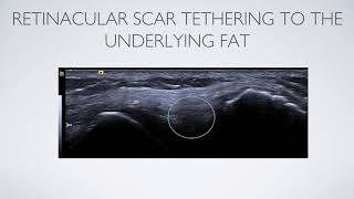 Dr Delzell Research Presentation of Patellar Retinaculum Ultrasound-guided Hydrodissection  AIUM '20